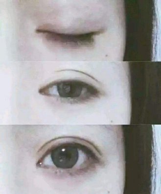 割内眼角有什么危害