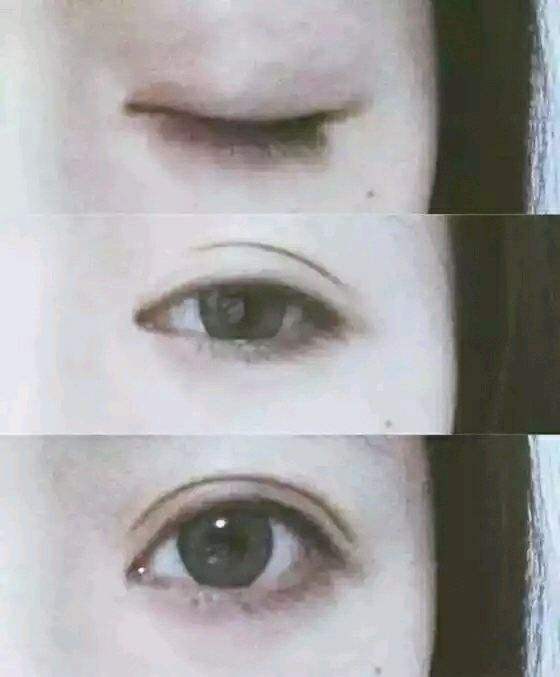 割内眼角有什么危害