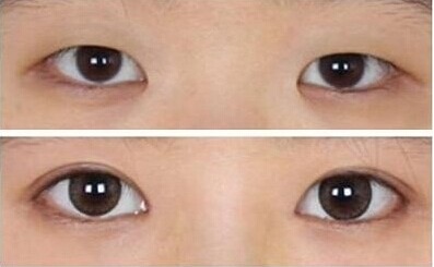 眼睛整容要多少钱