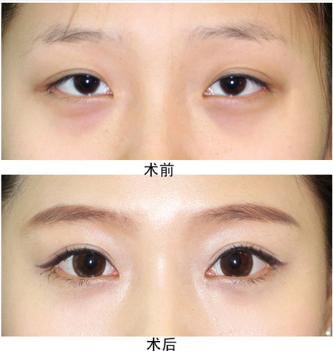 外眦开大的五种方法及优缺点