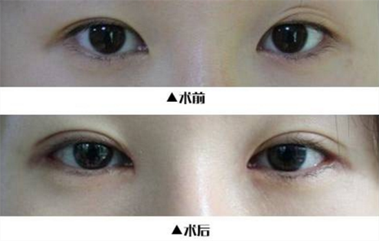 只开眼角多少钱呢