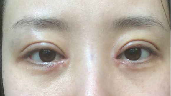 开眼角有小疙瘩怎么消
