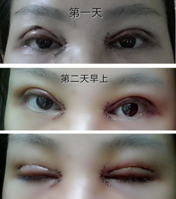 开眼角拆线过程图片