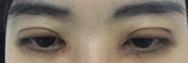 眼角增生3个月恢复图片