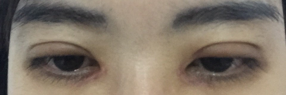 眼角增生3个月恢复图片