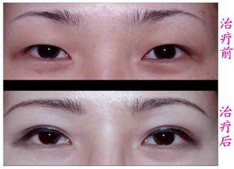 全切加开眼角要多少钱