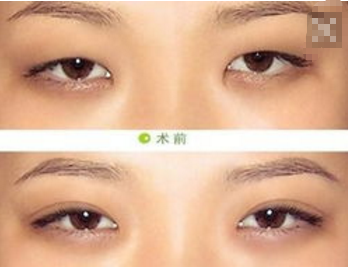 做双眼皮加开眼角多少钱