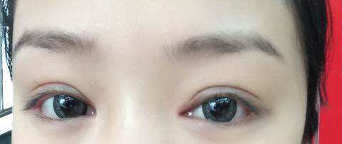 开眼角增生是什么意思