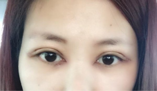 开眼角和做双眼皮效果怎么样