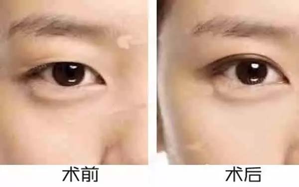 韩式开内眼角后注意事项