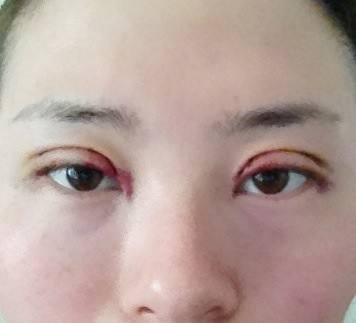 开内眼角手术有哪些过程