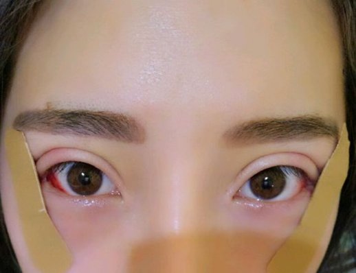 开内眼角手术风险及注意事项