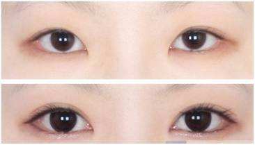 开眼角和双眼皮能一起手术吗