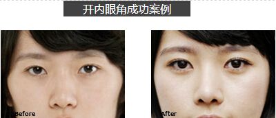 开眼角多久恢复几天可以上班
