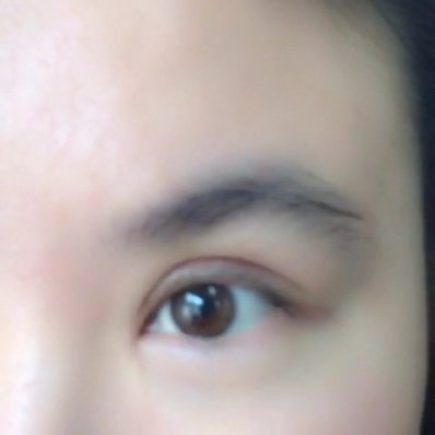 开内眼角适应者和禁忌人群
