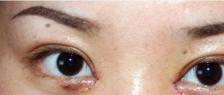 开内眼角手术会伤害眼睛吗
