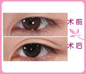 开内眼角手术价格大概是多少