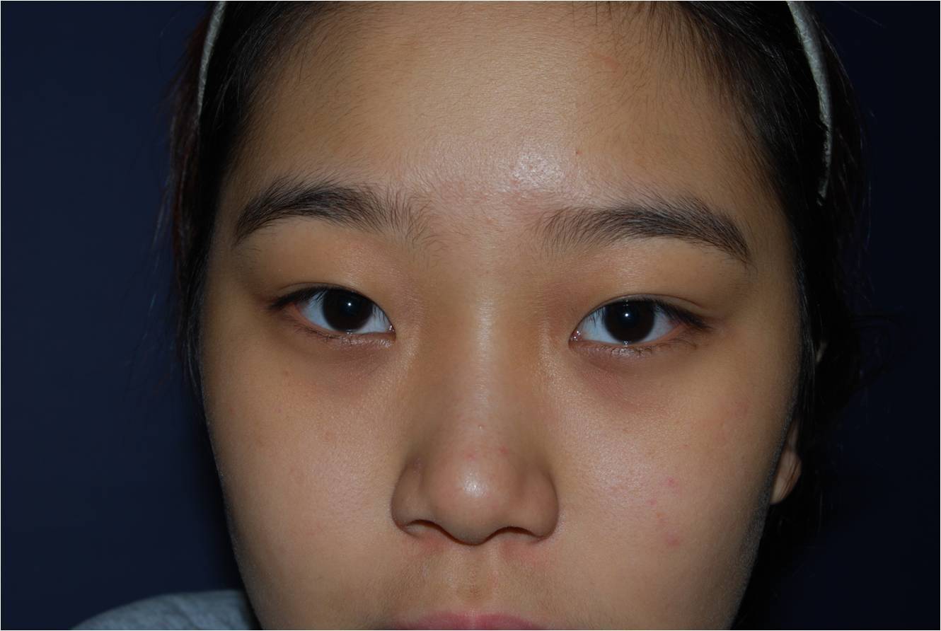 开眼角术的恢复期需要多久?