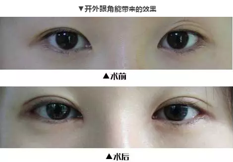 开外眼角适应人群有哪些