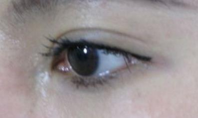 开眼角增生了怎么恢复