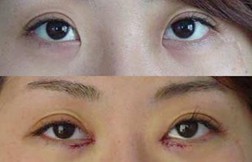 开内眼角的效果与优势有哪些