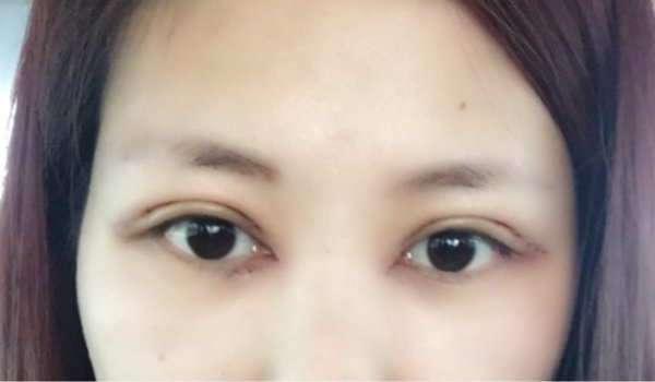 开眼角真的能让小眼睛变大吗