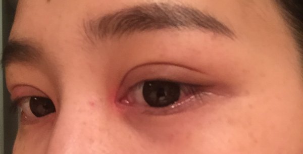 开眼角手术的优点有什么