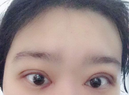 开眼角淤血怎么消除