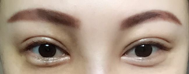宁波开眼角手术价格是多少钱