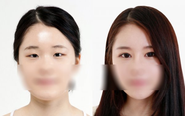 开封开眼角要多钱