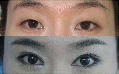 成都开眼角手术价格多少