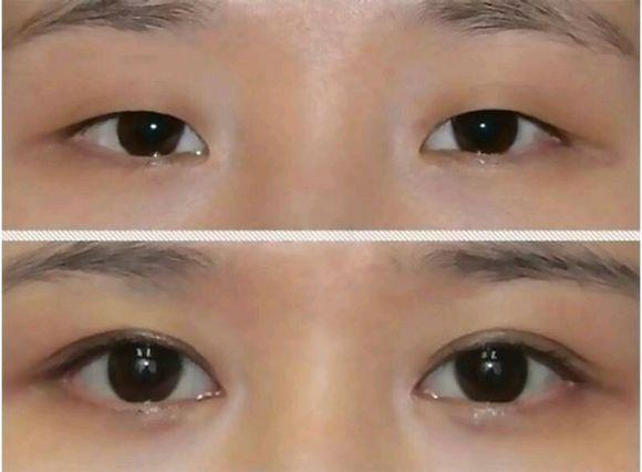 广州做开眼角的手术费用