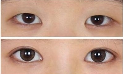 合肥开眼角手术价格多少