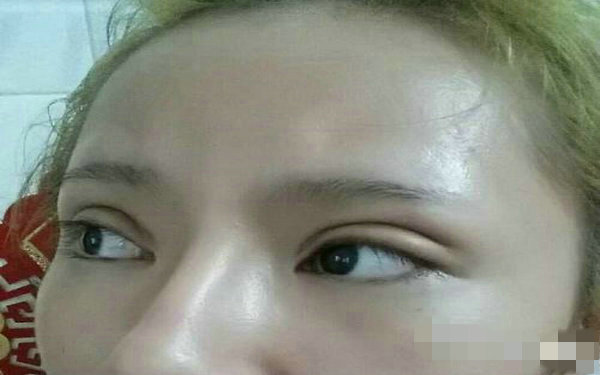 做眼袋手术需要多少钱？