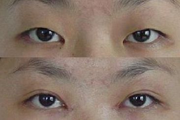 开眼角手术价格多少钱