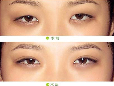 开眼角一定会留疤么