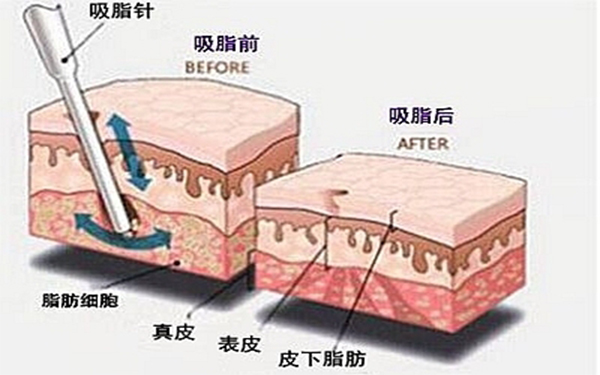 大腿水动力吸脂瘦身的好处和注意事项
