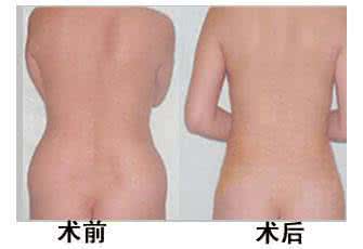 腰部吸脂恢复过程图