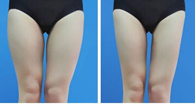 月经期间可以大腿吸脂吗
