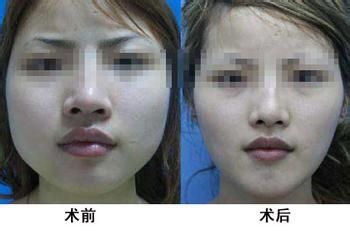 脸部抽脂的疼痛感和禁忌人群