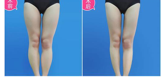 大腿抽脂多久可以上班