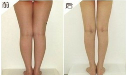 大腿抽脂多久可以同房