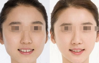 面部吸脂一般多少钱