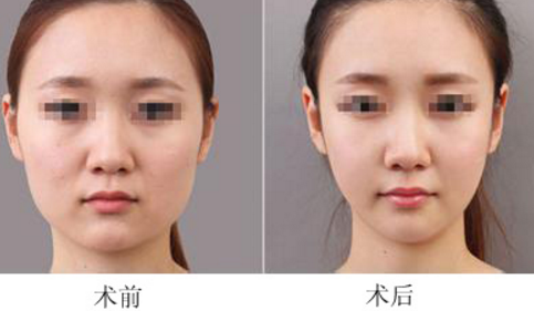 面部吸脂需要多少钱