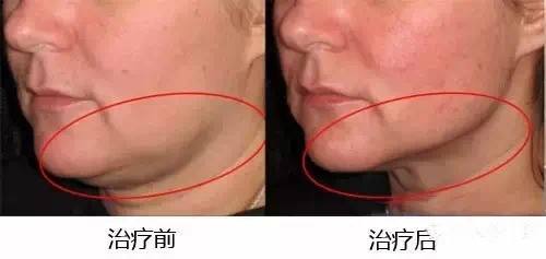 脖子能抽脂吗