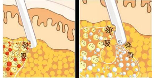 吸脂后多久能看出效果