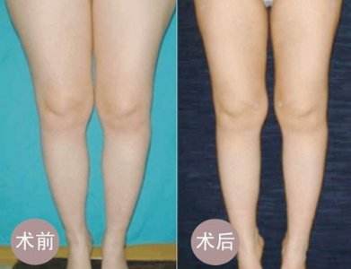 腿部吸脂的术后护理方法