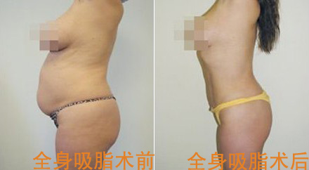全身抽脂分多少次 全身抽脂分多少次
