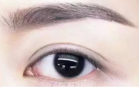 眼睛埋线后遗症有哪些