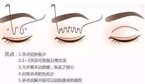 做双眼皮埋线能永久吗